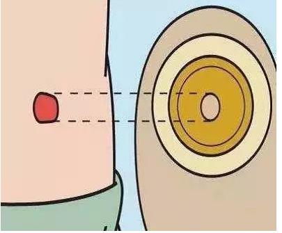 带你正确认识”造口袋“(图2)