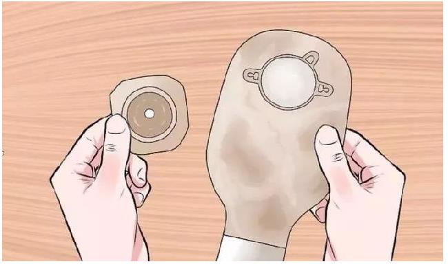 带你正确认识”造口袋“(图4)