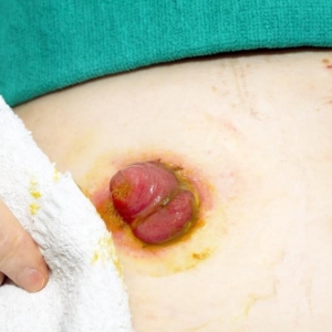 “造口人”需要我们更多地关爱